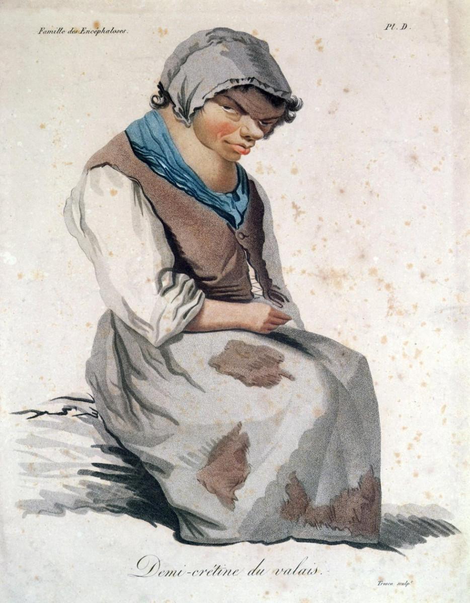 Illustration de Salvatore Tresca représentant une crétine du Valais, peinture qui se trouve au Musée d'Histoire de la Médecine à Paris.
